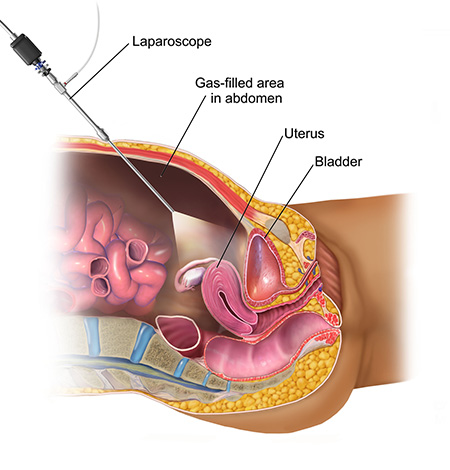 laparoscopy and robotic cancer specialist in delhi