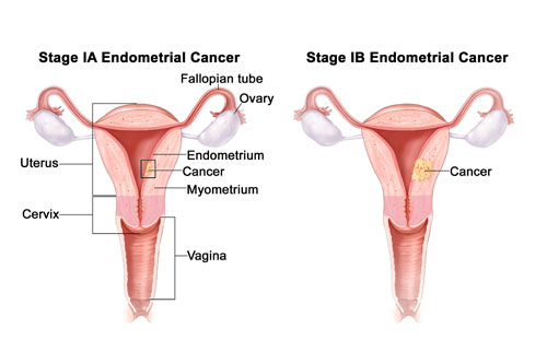 best doctor for esophageal cancer in delhi