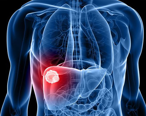 best liver cancer doctor in delhi