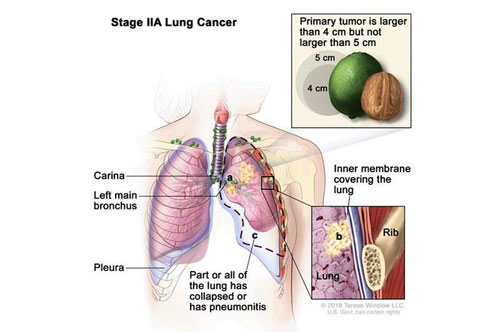 best doctor for lung cancer in delhi