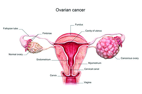 ovarian cancer specialist in delhi