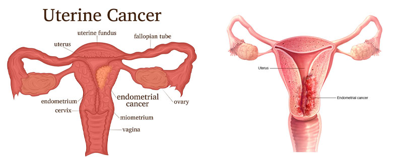 uterine cancer doctor in Gurgaon