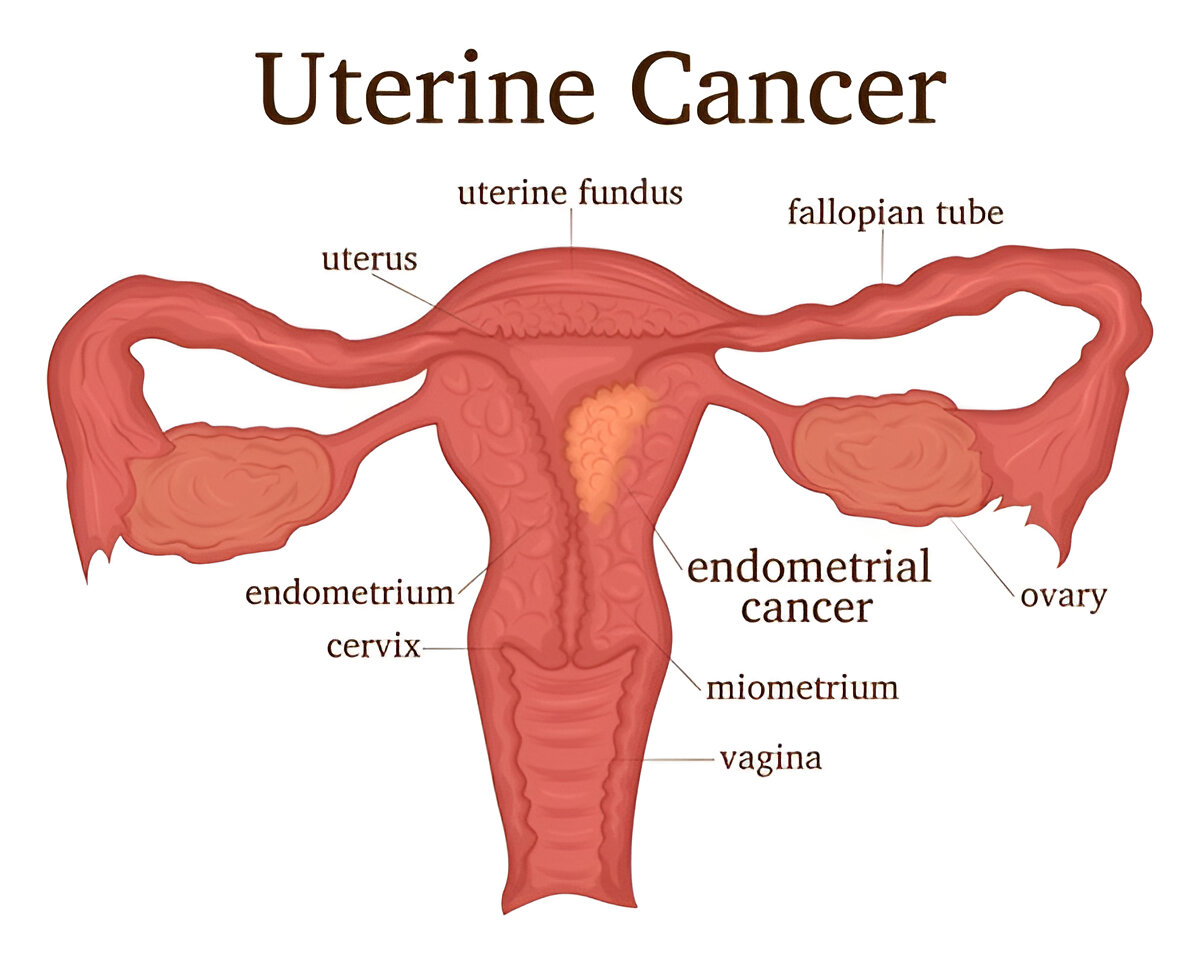 uterine cancer doctor in Gurgaon
