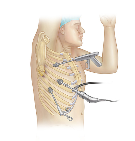 Video Assisted Thoracoscopic Surgery in delhi